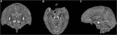 Nigral Iron Deposition Is Associated With Levodopa-Induced Dyskinesia in Parkinson’s Disease